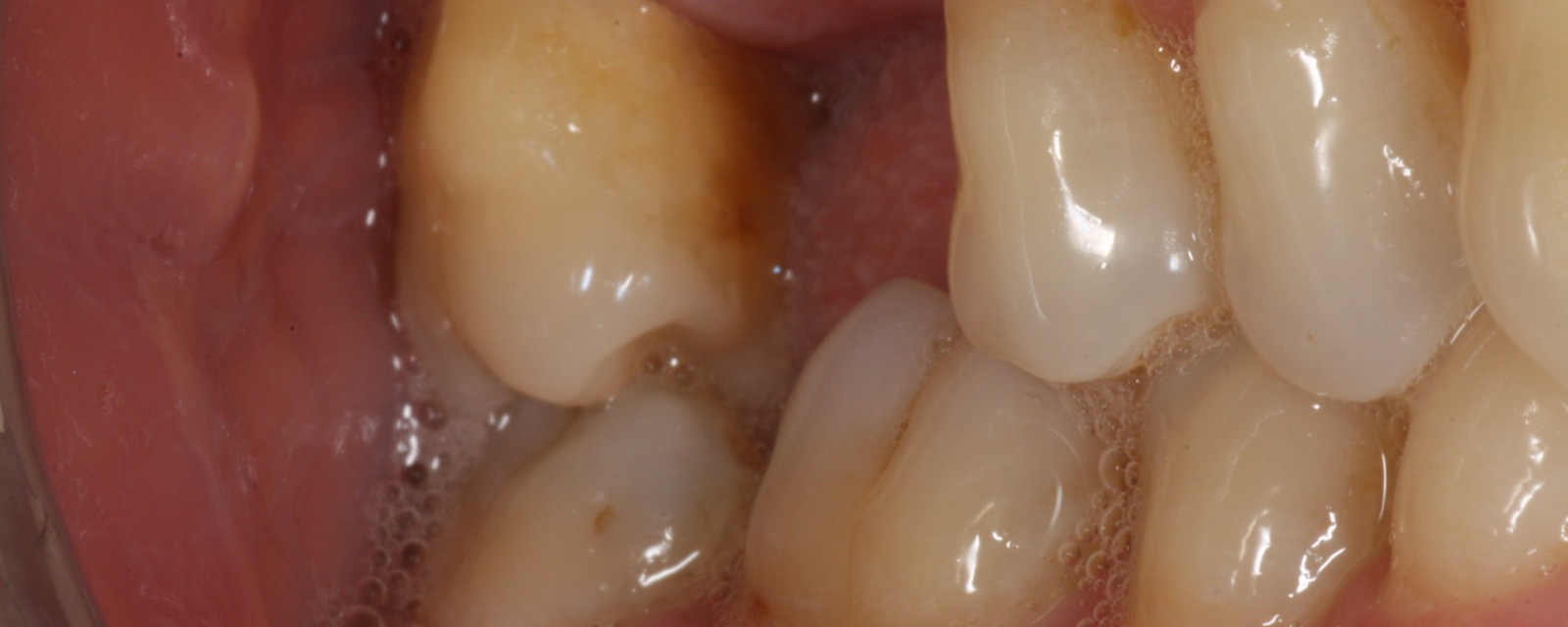 Přiadaptování kompozitní dlahy k sousedním zubům a modelace zubu v ústech pacienta – před